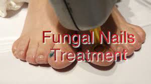 laser fungal nail treatment the