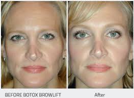 botox dysport ta eye clinic