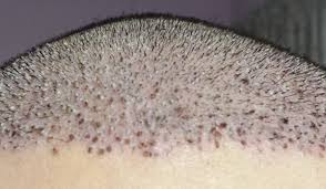 scabs after hair transplant dhi panamá