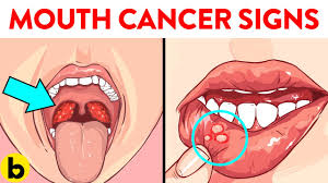 6 early signs of mouth cancer you