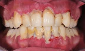 calcium deposits on teeth causes