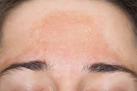 melasma brown spots or sun spots