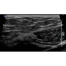   YO male bilateral lower abdominal pain Ultrasound Case studies in Comer s  Emergency Room  Startradiology