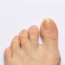 yellowing toenails treatment nail