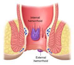 Read more in the article what are internal hemorrhoids on our website. Colon And Rectal Conditions Hemorrhoids Scl Health