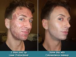 advanced laser skin resurfacing