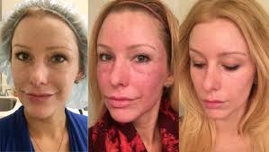 before and after co2 laser skin resurfacing