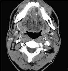 clinically sed t4n3 carcinoma at the