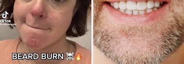beard infection from kissing