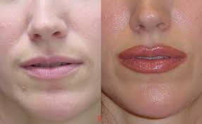 lip augmentation upper and or lower