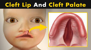 what causes cleft lip and cleft palate