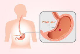 stomach ulcers signs treatment do