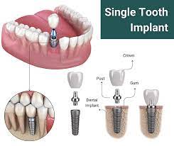 single tooth implant in nj riverside