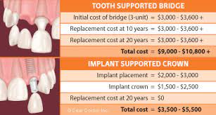cost of implants to fixed bridgework