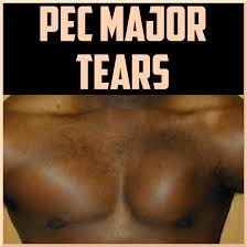 pectis major tears sports