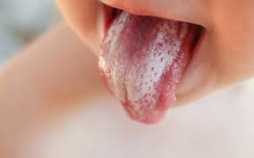 thrush vs milk tongue what is