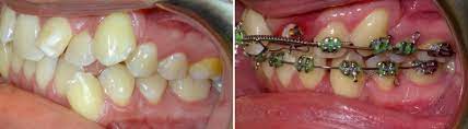 In case of surgical extraction the bones are to be healed up without undergoing any complication. When Why You Need Tooth Extraction For Orthodontic Treatment