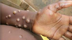 Monkeypox: What we know about the ...