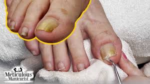 how to get rid of yellow toenails