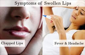 swollen lips lip edema symptom evaluation