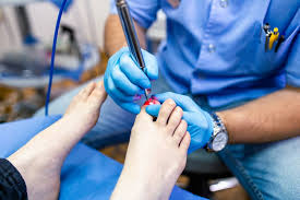 laser treatment for toenail fungus to