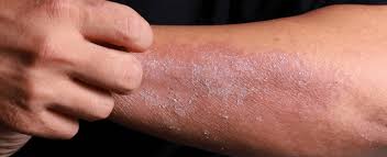 can seasonal allergies cause eczema