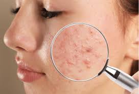 treating acne with the help of a