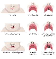 cleft lip palate surgery arlington