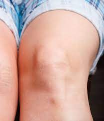 how can i treat dark knees and elbows