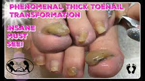 thick toenails with nail fungus