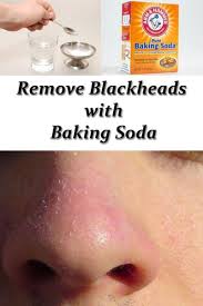 baking soda to remove blackheads