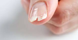 brittle nails causes symptoms