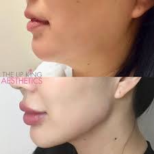 By using fillers we can enhance the volume of your face. This Client Had 2ml Of Jawline Filler Along With Botox Injections In Her Masseter Muscle This Relaxes The Mu Facial Fillers Prevent Hair Loss Botox Injections
