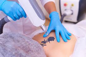 laser tattoo removal dermaenvy