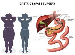 gastric byp surgery nj gastric