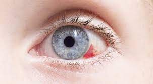broken blood vessel means for your eye
