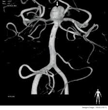 Un aneurisma cerebral es una zona debilitada y abultada en la pared de una arteria cerebral una tac puede ayudar a ver el aneurisma, pero sobre todo muestra la sangre de la hemorragia. Reconstruccion 3d Angiografica En El Diagnostico Y El Tratamiento De Aneurismas Cerebrales Imagen Diagnostica