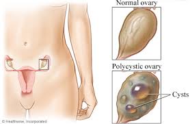 Ultimately, getting your laser hair removal covered by insurance will depend very much on your doctor and how understanding they are with your appearance issues. Polycystic Ovary Syndrome Pcos Cigna