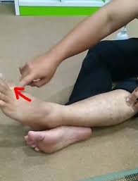 Ciri umum bunion adalah adanya rasa sakit dan kulit yang memerah di atas tonjolan sendi jempol kaki. 3 Point Urutan Sakit Tapak Kaki Ibu Jari Kaki