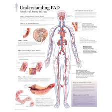 Understanding Pad Peripheral Artery Disease Chart
