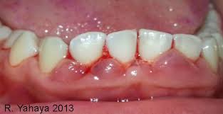 periodontal gum disease in pregnancy