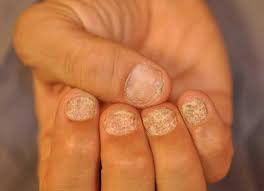 nail dystrophy definition causes