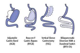 bariatric surgery weight loss surgery