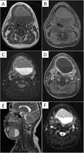 mri findings of a dermoid cyst in the
