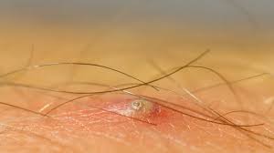Ingrown Hair on Penile Shaft: Removal, Identification, and Causes