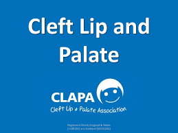 ppt cleft lip and palate powerpoint