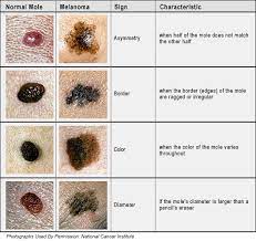 Stage 0 and i are localized, meaning they have not spread. The Abcdes Of Melanoma Sero