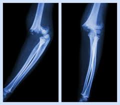 A fracture of the medial epicondyle of the elbow that is the third most common fracture seen in children and is usually seen in boys between the medial epicondyle. Medial Epicondyle Fracture Of The Humerus