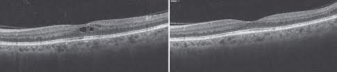 managing cme after cataract surgery