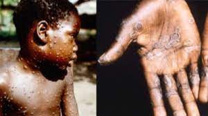 Jun 10, 2021 · two cases of monkeypox have been identified in north wales, health bosses said. Monkeypox Outbreak In North Wales As Two Treated For Rare Viral Infection Itv News